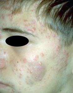 fig-1-acne
